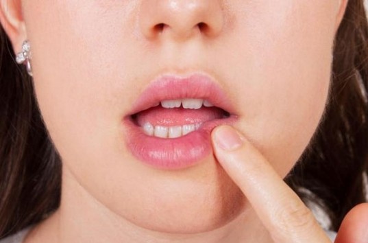 Причины появления герпеса на губах, его симптомы и лечебные процедуры