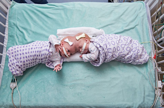 Сросшихся головами сиамских близнецов разделили медики в США (ВИДЕО)