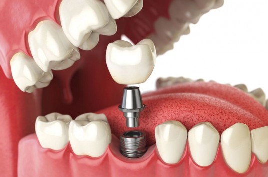 Основные этапы имплантации зубов