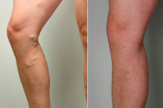 Удаление варикозных вен на ногах: современные методы процедур и их особенности