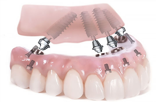Виды зубных имплантов и протезов