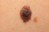 Які ознаки меланоми бувають у літніх